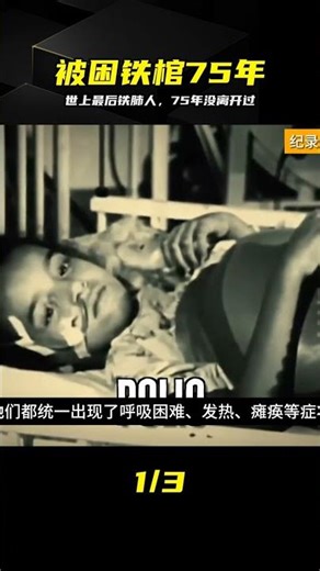 困在鐵皮棺里75年，世上獨一鐵肺人的一生 #铁肺，铁肺人，奇人异事，被困75年，罕见病
