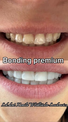 Ta metamorfoza to dowód, że czasem wystarczy jeden odważny krok, by otworzyć zupełnie nowy rozdział. Pacjentka zaufała procesowi, a my zadbaliśmy o każdy detal, by efekt był harmonijny i spójny z uśmiechem. Najpiękniejsze w takich zmianach jest to, że zaczynają się od decyzji – “spróbuję”. A potem dzieje się magia. Zapraszam do kontaktu: pon, śr, czw 7:30- 19:30 wt, pt 14:30 - 19:30 📞 731 898 629 📞 32 70 44 449 💌 klinika.usmiechu1@gmail.com Chorzów, ul. Kopalniana 1 #białezęby #prostezęby #me