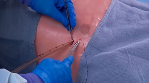 Securing a chest tube - Mayo Clinic
