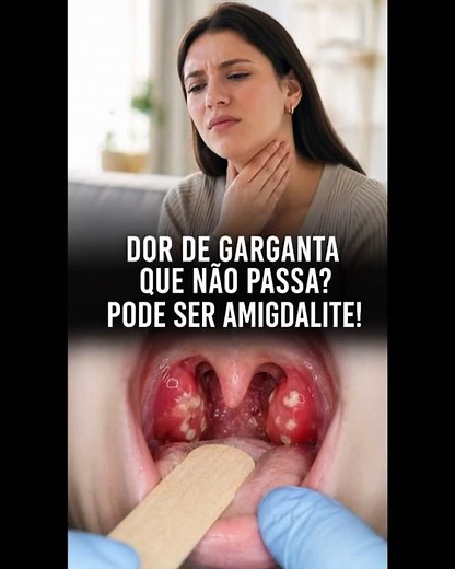 AMIGDALITE #saude #amigdalite #dordegarganta #telemedicina