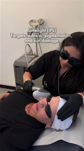 RA Clinics | Vascular Laser in Summer? Limelight & Laser Genesis Explained