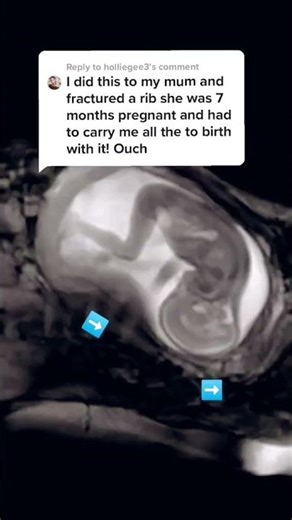 fetal MRI
