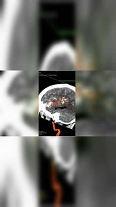 左侧大脑中动脉多发动脉瘤3D-DSA与CT融合矢状位动态