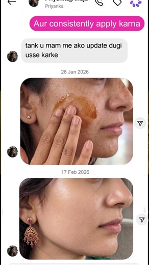 This👆🏼Skin Brightening Cream-Clears Face Pigmentation Gives Even & Glowing Skin #clove #cream #laung