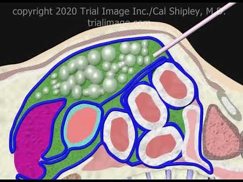 Peritoneal Tap to treat Necrotizing Enterocolitis (NEC Part 3) Animation by Cal Shipley, M.D.