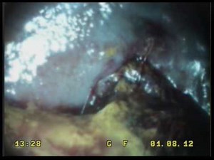 Colon after intussusception, dog