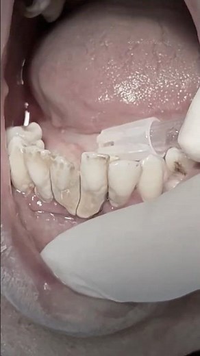 Heavy calculus scaling and extraction of mobile teeth to replace with bridge soon #dentist #shorts