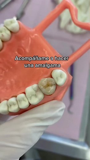 Dental Amalgam Procedure Explained Step by Step
