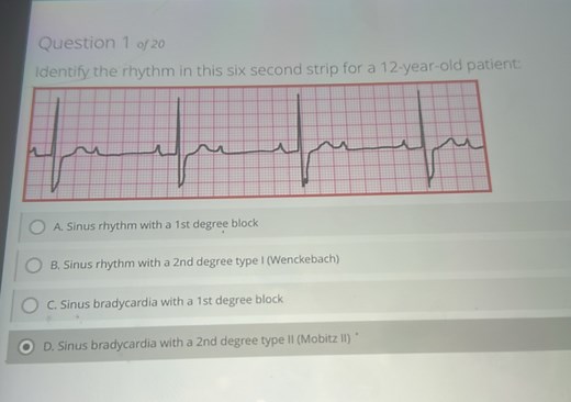 Identify the rhythm in this six second strip for a 12-year-old patient: