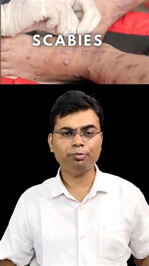 What is Scabies ? | Permethrin #shorts #scabies #permethrin