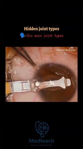 How Artificial Lenses Are Inserted Into the Eye | Eye Surgery Explained #youtubeshorts