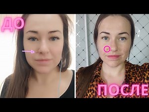 SCARS after MOLE REMOVAL. Is it possible to remove moles on the face?