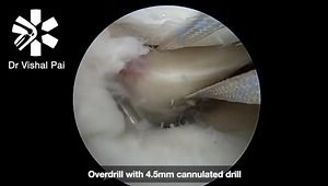 Medial Meniscus Root Repair