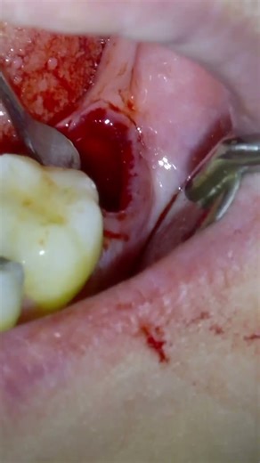 SATISFYING Extraction on Lower Molar Tooth! #Satisfying #Extraction