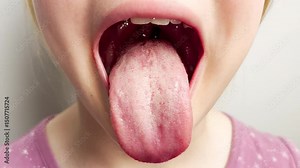 Close up of a human child open mouth with tongue extended and visible throat, tonsils, and uvula. Medical or dental examination concept with bright lighting. Red throat close up.
