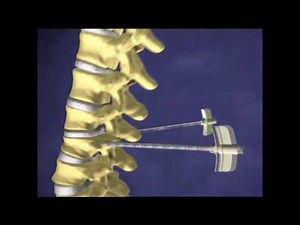 Vertebroplasty / Kyphoplasty
