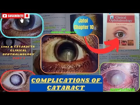 Complications of Cataract | Jatoi Clinical Ophthalmology | Chapter 10 Part 7