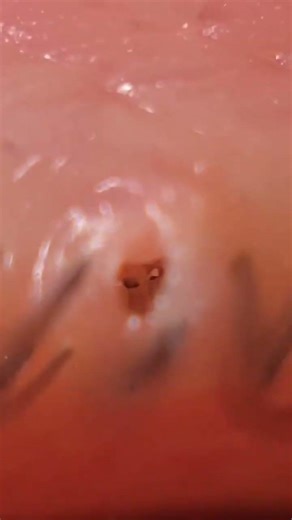 Hidden Microbes Crawling at Your Eyelid Margin?