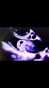 🎃 Happy Halloween from The Echo Journal! 👻 What spooky echocardiographic finding do you see here? 👀 Comment your guess — and repost to challenge your echo friends! 🫀 | The Echo Journal