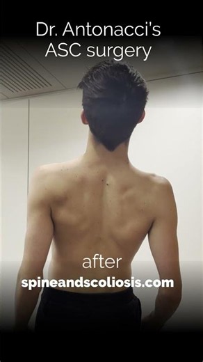 Scoliosis Before & After Spine Surgery