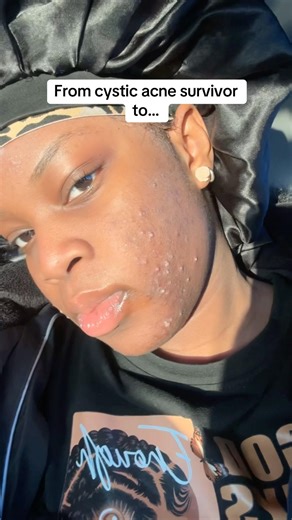 Turned cystic acne struggle into a Skin Reset Guide. Comment RESET for blueprint #acneskincare #skin