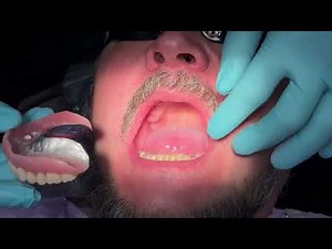Transforming Smiles: Witness the Astonishing 'Snap' of an Upper Denture - A Life-Changing Experience