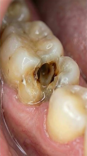 This Hidden Cavity Was Growing Between Teeth 😳 | Satisfying Repair #satisfying #asmr
