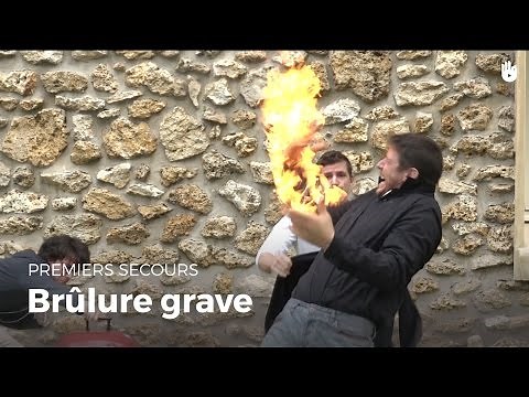 First Aid: Serious Burn | First Aid