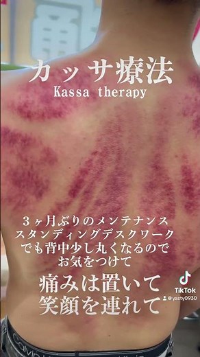 カッサ療法！３ヶ月バリバリ働いて背中が硬くなった方の色🟥整えました‼️#カッサ