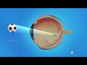 CPC for Glaucoma Treatment