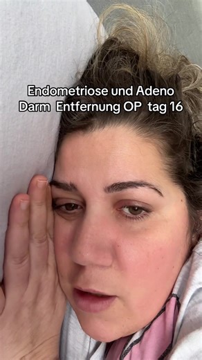 Understanding Endometriosis and Adenomyosis: Surgery Insights
