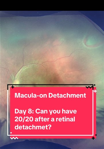 Can you have 20/20 after a retinal detachment? 👁️ Sometimes — and timing matters more than people realize. This is a macula-on retinal detachment. Tomorrow I’ll share what recovery can look like months later. #retina #eyedoctor #ophthalmology #womeninmedicine #surgeon