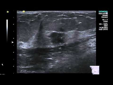 Breast Ultrasound cancer 2