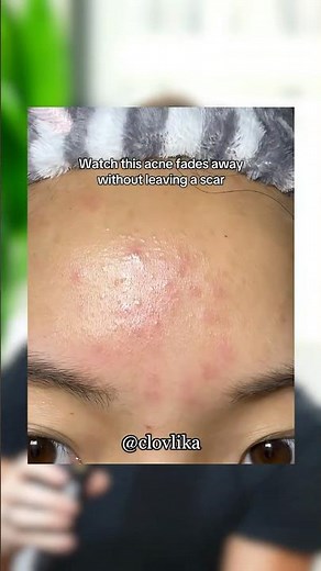 How To Actually Remove Acne Scars 😲