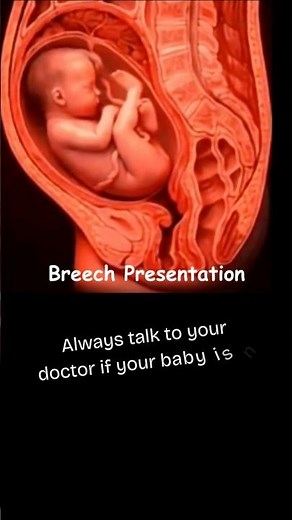 vaginal breach delivery || Your Baby Is Upside Down? Watch This! #shorts