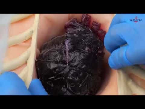 Malabsorption Syndrome Explained | Medical-Surgical Nursing | Digestive System Disorders---