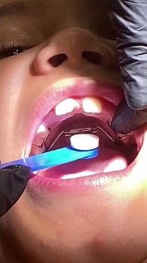 How to Turn a Fixed Palatal Expander | Step-by-Step Guide | Dr. Mila Cohen – True Dental Care