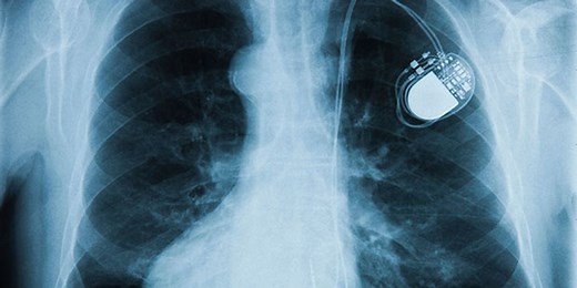 Expert Questions Claim That St. Jude Pacemaker Was Hacked