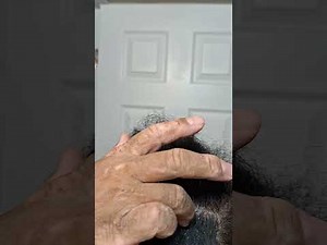 Dandruff scratching ASMR (sore by the end)