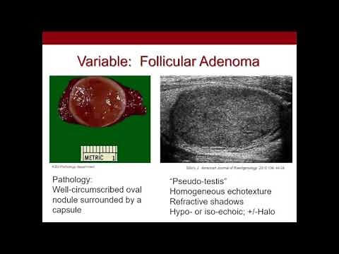Thyroid Nodules What We Know and What We Don't Ultrasound Video