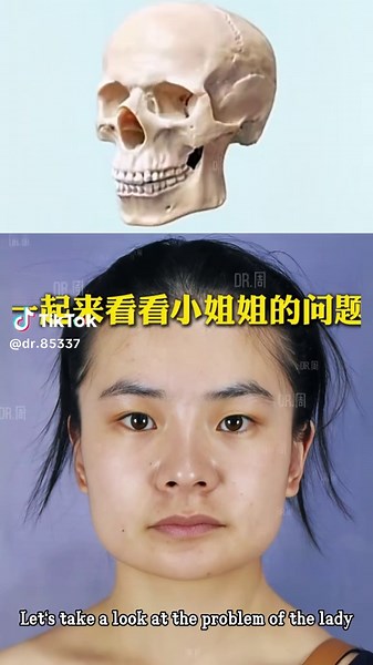 #磨骨 #磨骨手术 #磨骨手術 #faceshape #zygomaticbone #颧骨内推 #脸部轮廓 #面部轮廓 #face #矫正 #磨骨三件套 #脸型 #下颌角