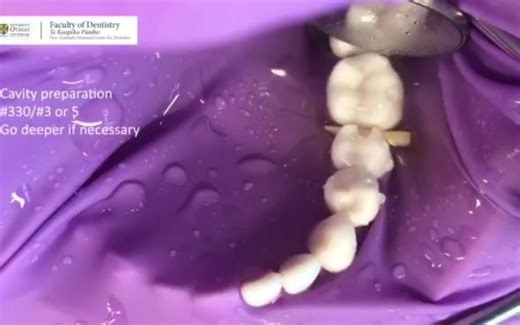 operative dentistry-邻面洞