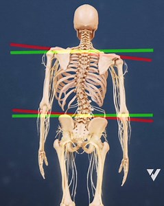 As degenerative scoliosis progresses, it can lead to noticeable postural changes, such as hunching forward, or uneven shoulders or hips. | Spine-health