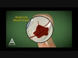 Stroke - 3D Medical Animation • Video • MEDtube.net