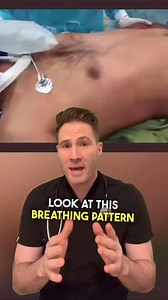 Dr. Joe, M.D. on Instagram: "Flail chest is a serious medical condition that occurs when multiple adjacent ribs are fractured in two or more places, causing a segment of the chest wall to become detached from the rest of the chest. This can result in paradoxical movement of the affected area, where it moves inward during inhalation and outward during exhalation, causing difficulty in breathing and potentially leading to respiratory failure. Flail chest is typically caused by blunt trauma to the 