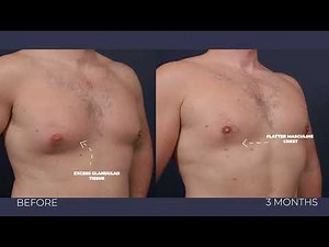 Male Gynecomastia Transformation | Excess Tissue Removal Results