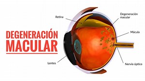 23 reactions | La degeneración macular relacionada con la edad es una...