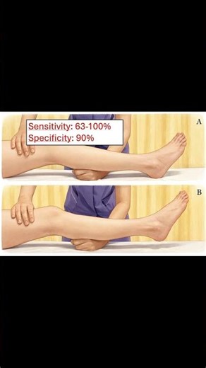 Lever Test (Lever Sign Test) 🦵🔍 ACL Rupture #meded #ortho #physio #ATC