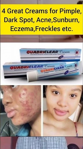 Best Creams for Pimple | Sunburn Acne | Dark Spots | Freckless Eczema.#skincare #viral #kizzdaniel