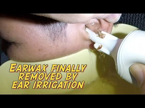 Hard Earwax Finally Removed by Ear Irrigation After 5 days of Ear wax Softener